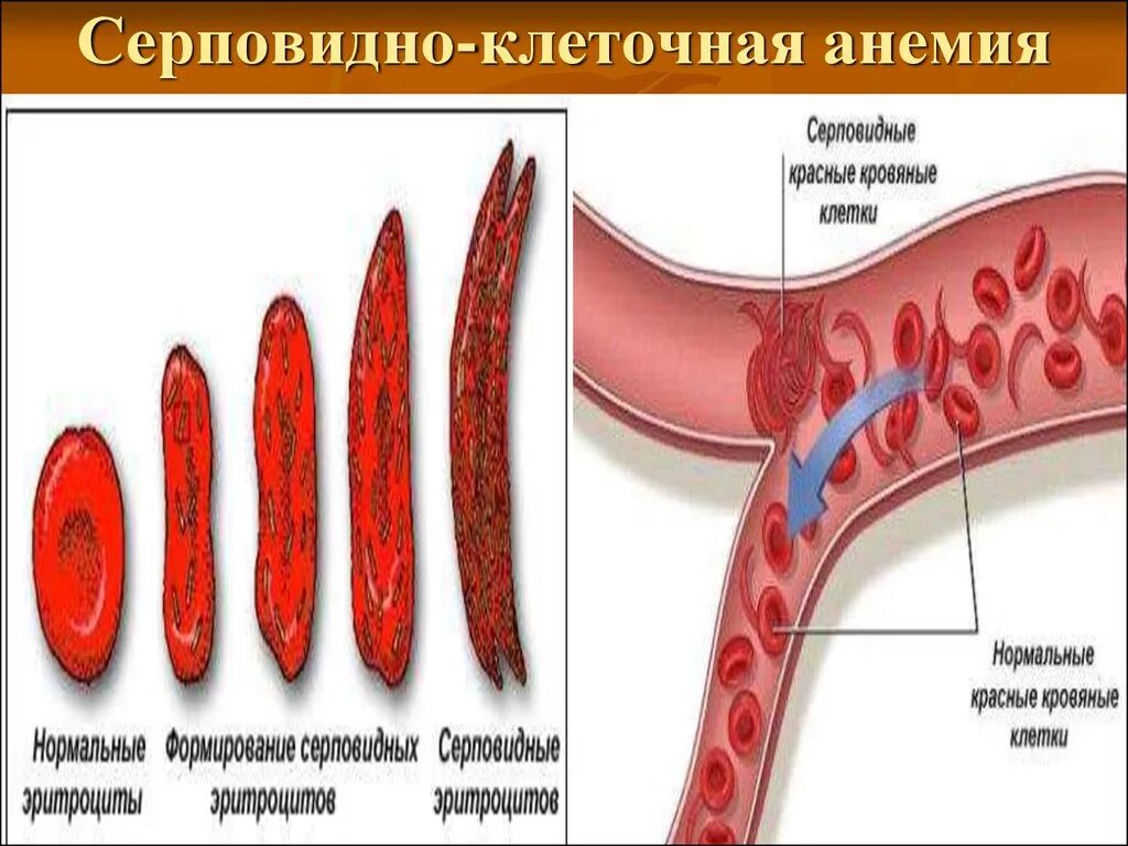 Серповидно клеточная анемия признаки. Серповидная анемия эритроциты. Болезнь серповидноклеточная анемия. Форма эритроцитов при серповидноклеточной анемии. Серповидная клеточная анемия симптомы.