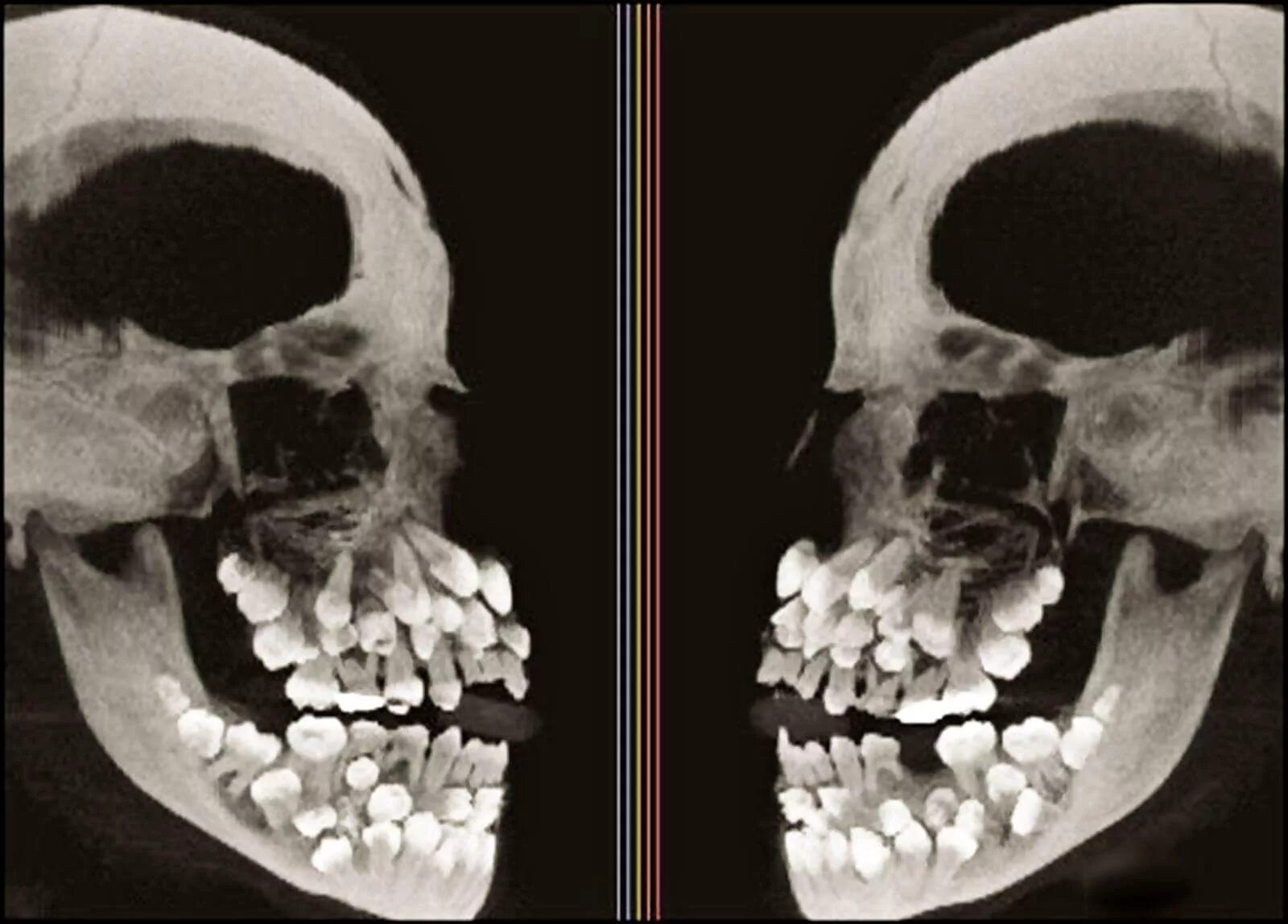 Детский череп рентген. Гипердонтией аномалия числа зубов. Полиодонтия - аномалия числа зубов,. Гипердонтия зубов рентген. Полиодонтия (сверхкомплектные зубы).