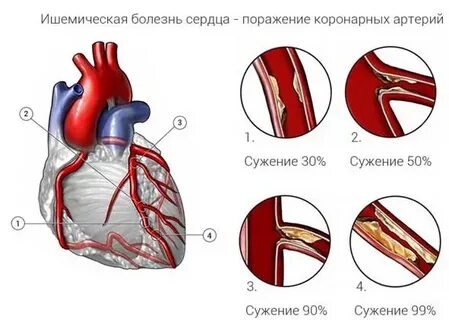 Ишемическая болезнь сердца 2023