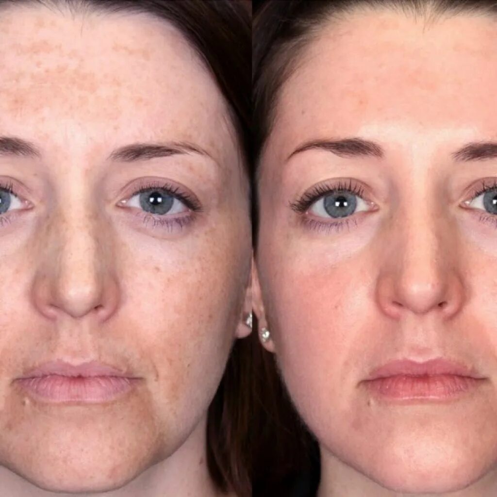 Лицо отбеливать пилинга. Маска для лица. Холодная плазма для лица от пигментных пятен. Маска для лица. Пилинг.