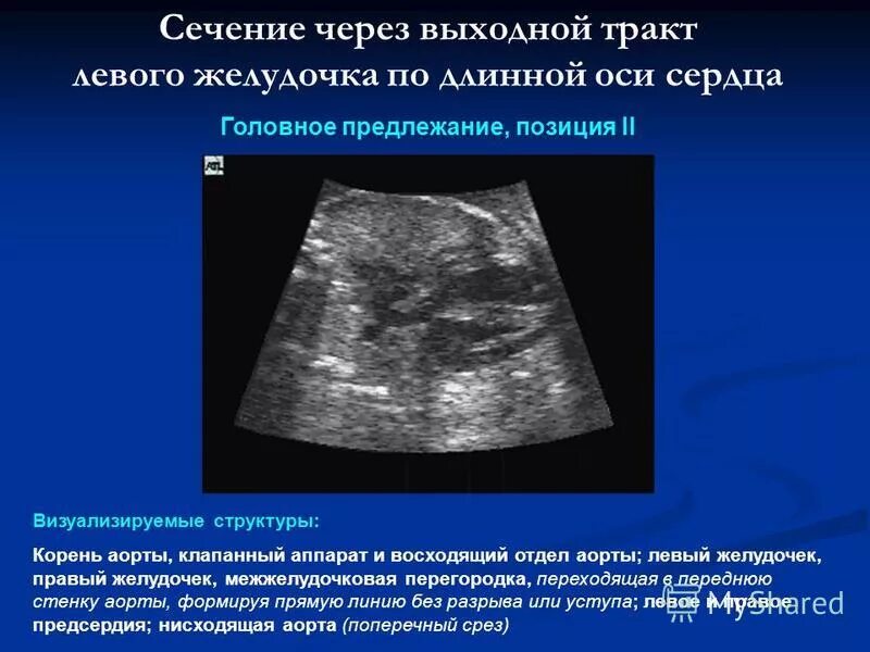 Обструкция выходного тракта левого желудочка. Экг желудочковая экстрасистолия аллоритмия. Стеноз выносящего тракта левого желудочка. Размер выносящего тракта левого желудочка. Стеноз выходного тракта левого желудочка степени.