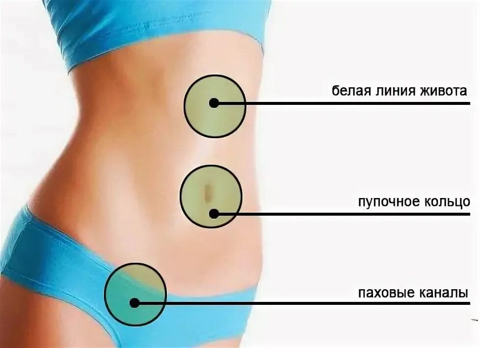 Белая линия живота и пупочное кольцо. Грыжа в верхней части живота.