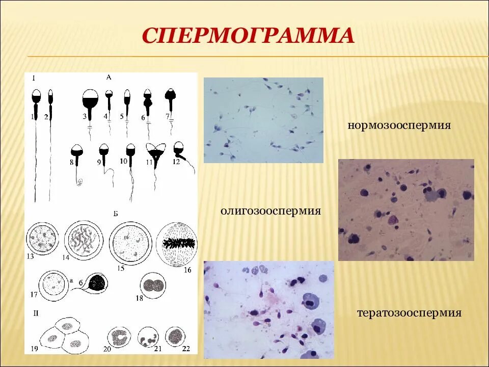 Спермограмма нормозооспермия. Заключение спермограммы нормозооспермия. Нормозооспермия показатели спермограммы. Спермограмма при азооспермии. Спермограмма нормозооспермия.