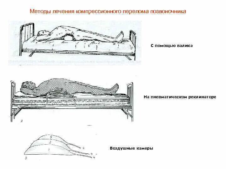 Почему нельзя сидеть при компрессионном переломе. Валик при компрессионном переломе позвоночника. Неосложненный компрессионный перелом. Компрессионный перелом позвоночника положение лёжа. Вытяжение при компрессионном переломе позвоночника.