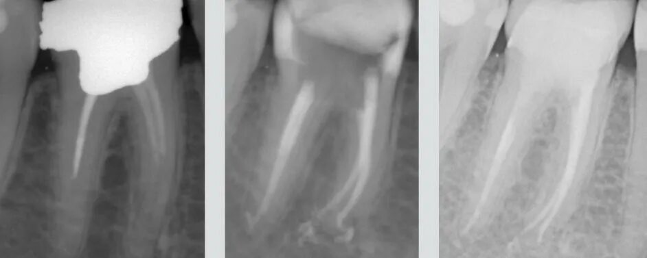 Расширение каналов зубов. Обтурация корневого канала рентген. Апикальный периодонтит рентген. Пломбировка каналов зуба рентген.