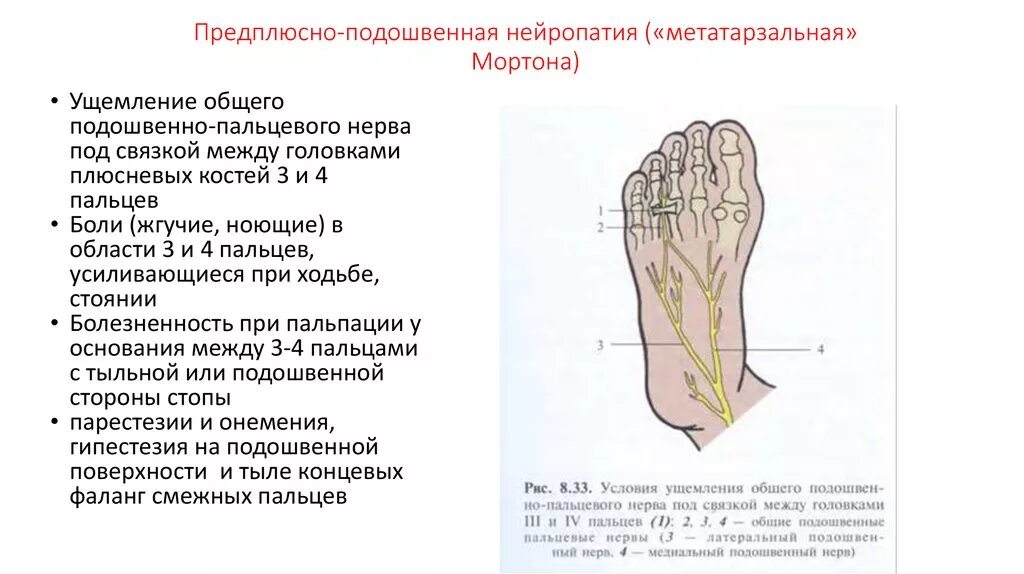 Область подошвы. Предплюсна подошвенная нейропатия. Подошвенный нерв область иннервации. Медиальный подошвенный нерв стопы. Туннельная невропатия стопы.