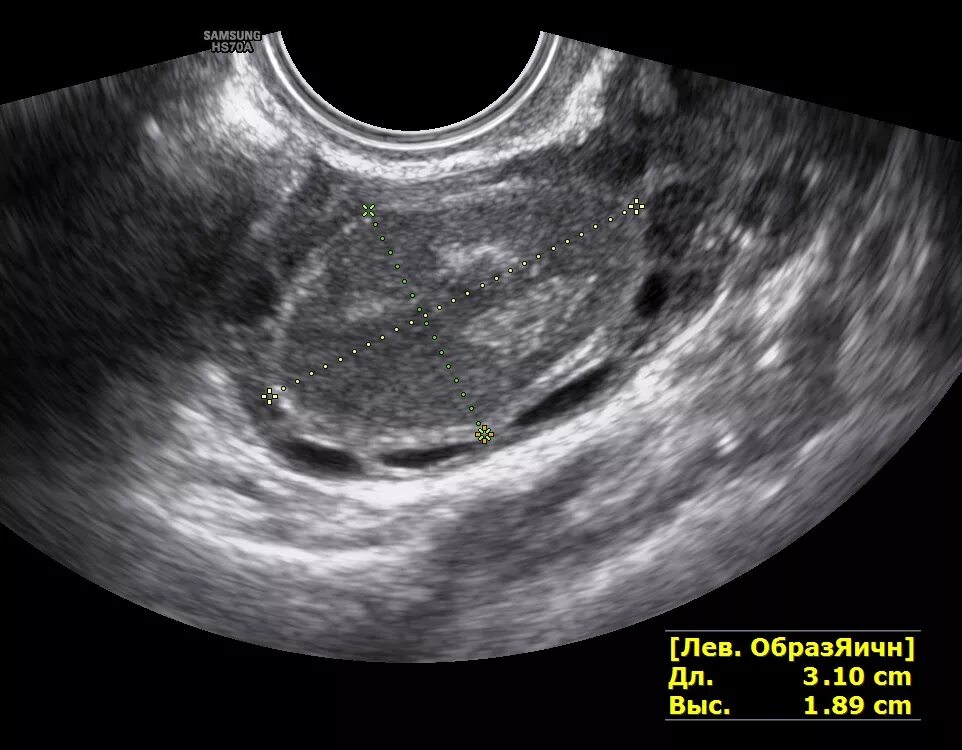 Полость матки деформирована. Стромальный текоматоз яичников УЗИ. Аденофиброма яичника УЗИ. Кистома текома яичников. Текома опухоли яичников.