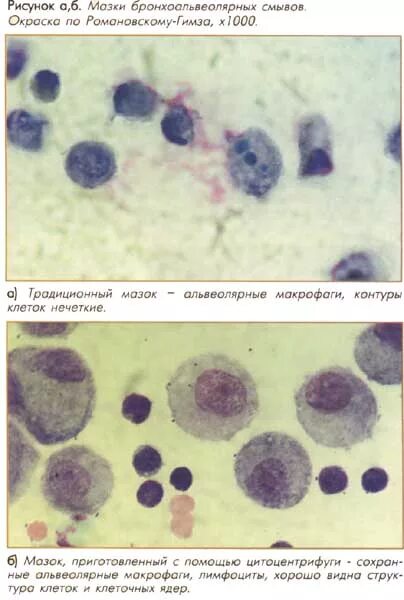 Альвеолярный мокроты