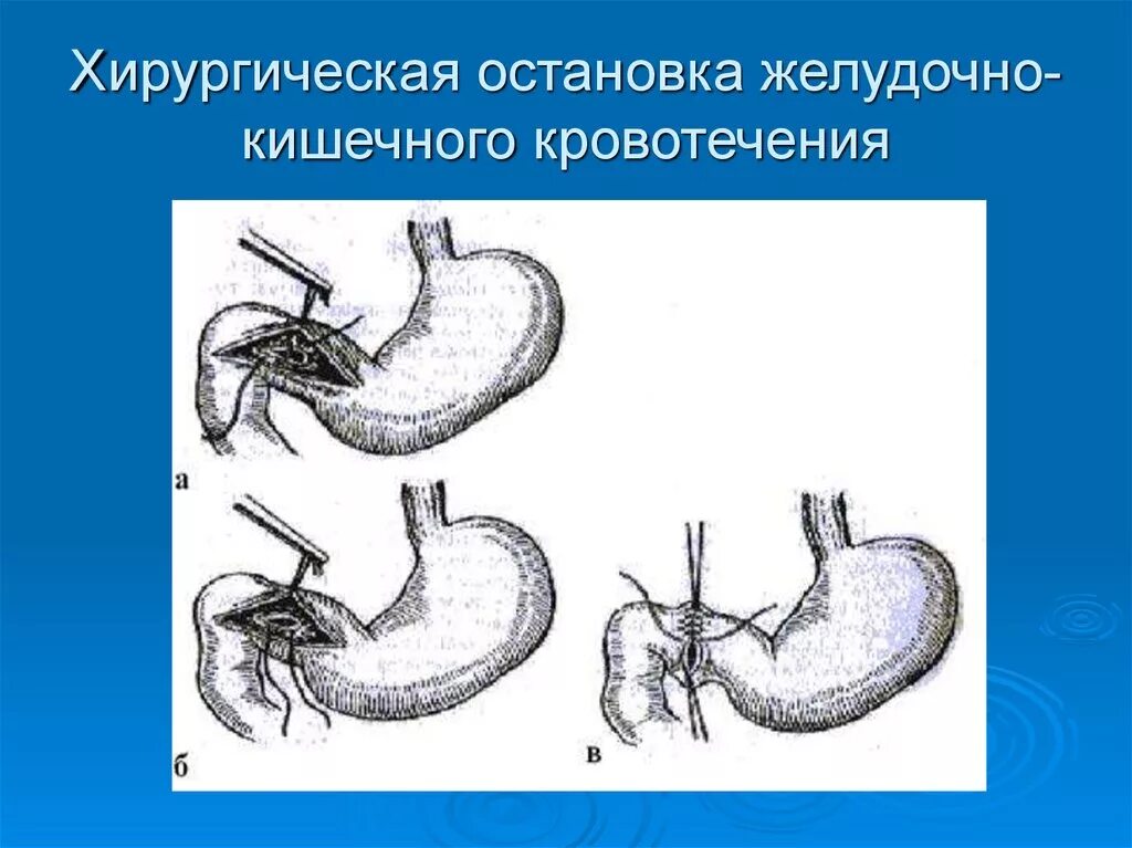 Желудочно кишечные кровотечения терапия. Клипирование кровоточащего сосуда язвы желудка. Язвенные желудочно-кишечные кровотечения. Хирургические методы остановки желудочно кишечного кровотечения. Остановка кровотечения желудка.