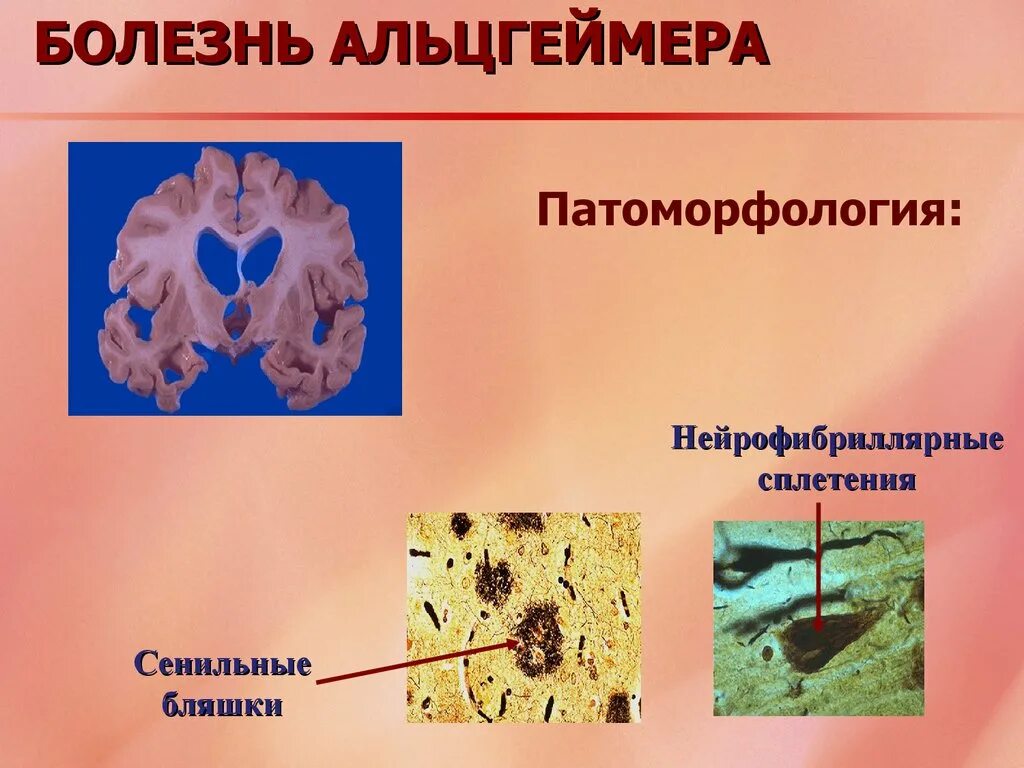 Болезнь айцгельмера это что. Болезнь Альцгеймера. Патоморфология болезни Альцгеймера. Сенильные бляшки для болезни Альцгеймера. Сенильные бляшки при болезни Альцгеймера.