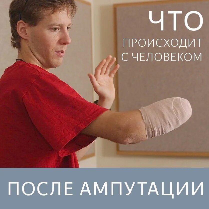 Человек без левой руки. Человек с ампутированной рукой.