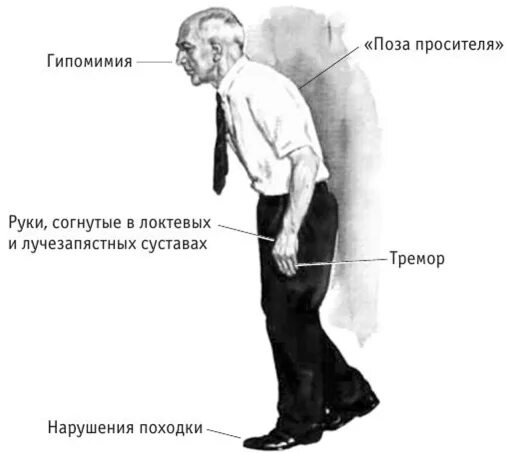 Бехтерева паркинсона. Болезнь паркинсона симптомы и признаки у пожилых. Бехтерева паркинсона. Бехтерева паркинсона. Болезнь паркинсона.