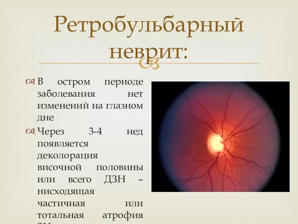 Ретробульбарный неврит периферическая форма. Ретробульбарный неврит периметрия. Ретробульбарный неврит глазное дно. Неврит зрительного нерва и ретробульбарный неврит.