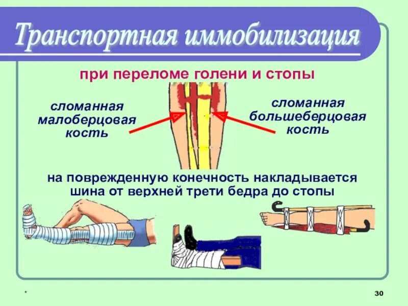 Транспортная иммобилизация при переломе голени. Транспортная иммобилизация большеберцовой кости. Перелом костей стопы транспортная иммобилизация. Транспортная иммобилизация при переломе костей конечностей.