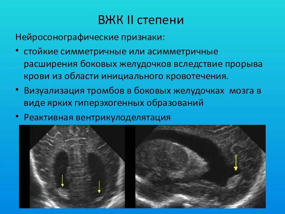 Тромб в желудочке. Степени внутрижелудочкового кровоизлияния. Внутрижелудочковое кровоизлияние у новорожденных 2 степени. Степени внутрижелудочкового кровоизлияния у новорожденных. Кровоизлияние ВЖК У новорожденных.