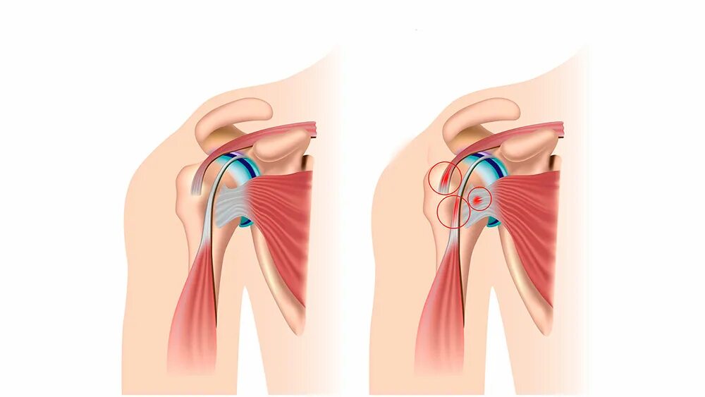 Плечевой сустав. Сустав плеча. Тендинит плечевого сустава. Стучит плечо