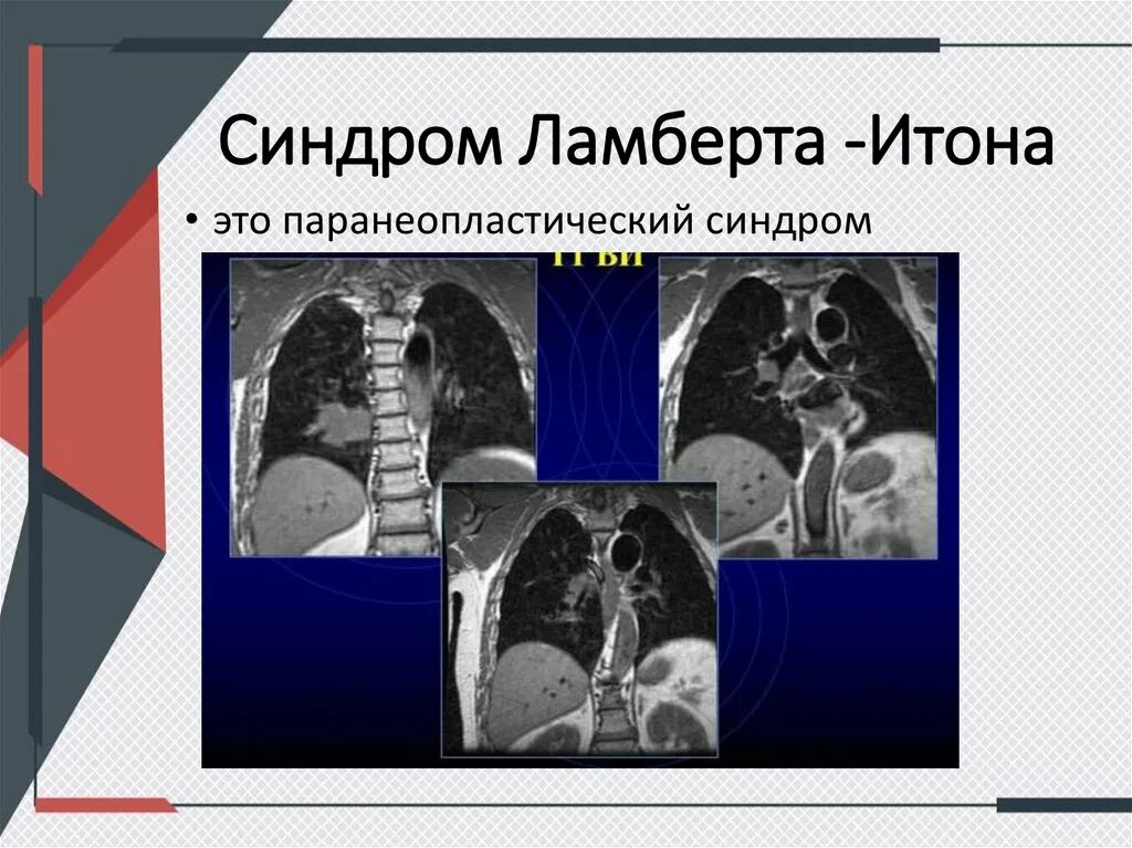 Синдром ламберта итона патогенез. Миастенический синдром ламберта-итона патогенез. Паранеопластические синдромы классификация. Миастенический синдром ламберта. Паранеопластические синдромы схема.
