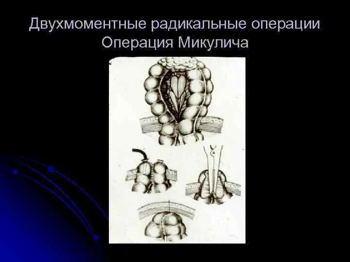 Резекция по микуличу. Операция микулича на кишке. Резекция по микуличу. Резекция сигмовидной кишки колостома. Операция микулича грекова.
