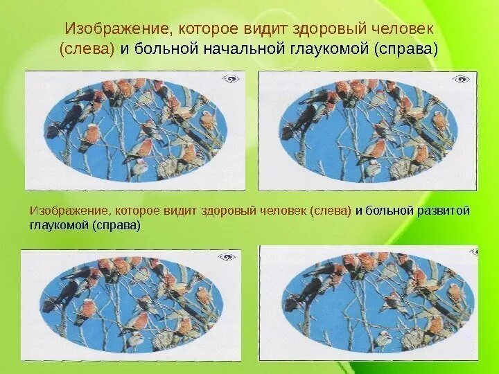 Как видит здоровый человек. Как видит больной глаукомой. глаукома что видит человек. как видит человек с глаукомой.