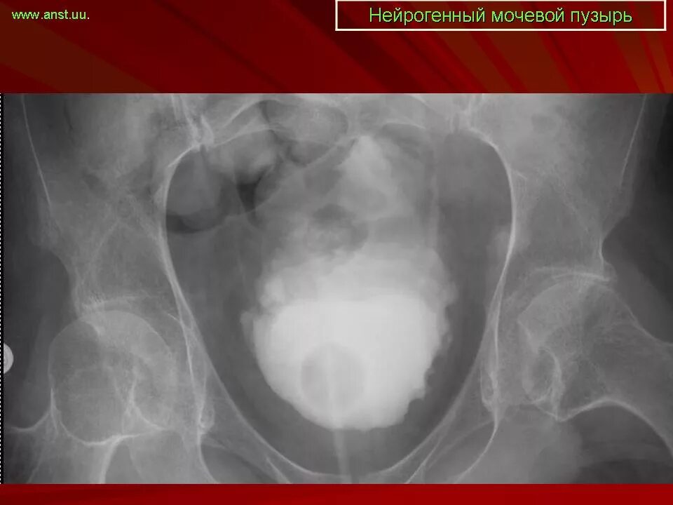 Нейрогенный мочевой у мужчин. Нейрогенный мочевой пузырь цистография. Цистография мочевого пузыря рентген. Нейрогенный мочевой пузырь рентген. Гипертрофия мочевого пузыря рентген.