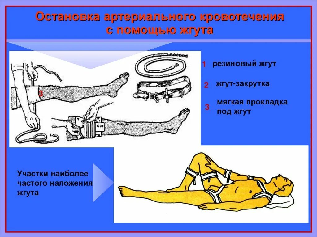 Алгоритм наложения жгута при артериальном кровотечении. Остановка артериального кровотечения с помощью жгута. Жгут закрутка наложение алгоритм. Наложение жгута закрутки при артериальном кровотечении алгоритм. Алгоритм остановки кровотечения жгутом закрутки\.