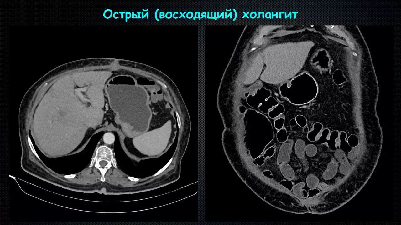 Холангит у кошек. Склерозирующий холангит мрт. Хронический холангит кт. Первичный склерозирующий холангит кт.