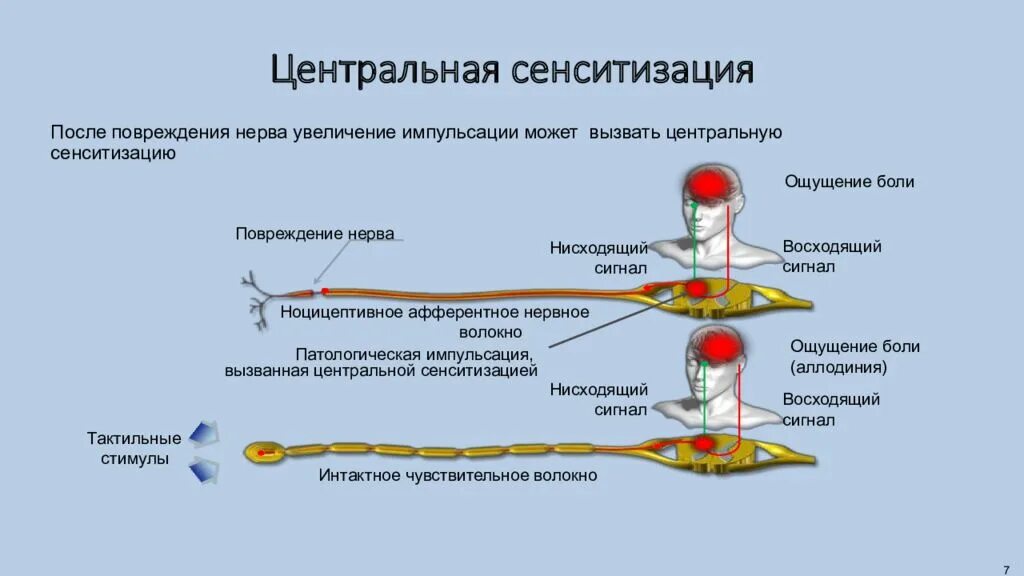 Повторяющиеся эпизоды центральной сенситизации