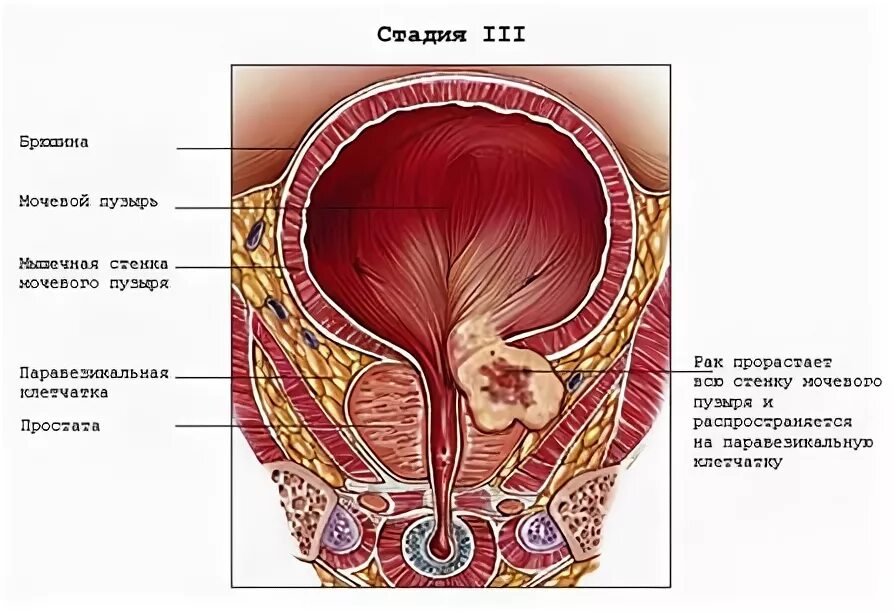 Паравезикальная клетчатка. Опухоль мочевого пузыря. Опухоль мочевого пузыря у женщин. Паравезикальной клетчатки мочевого пузыря. Опухоль мочевого пузыря т3.