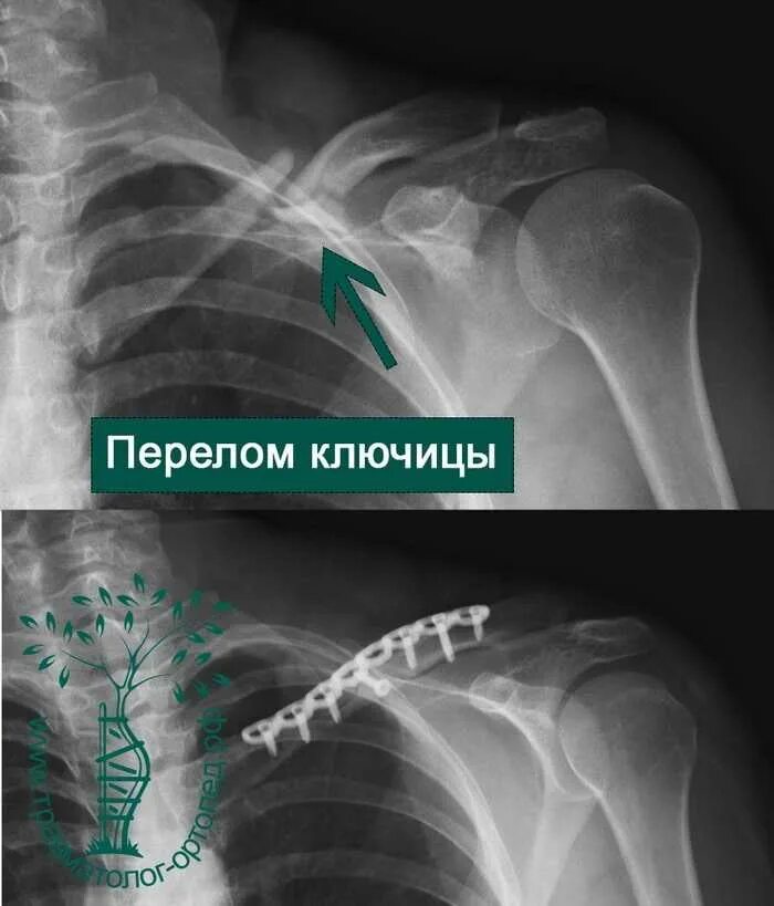 Оскольчатый перелом ключицы. Оскольчатый перелом ключицы