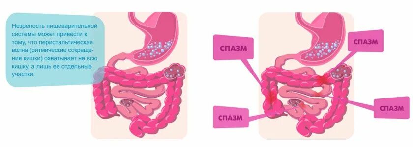 Почему спазмы в животе. Спастическое сокращение кишечника. Спазмы тонкого кишечника.