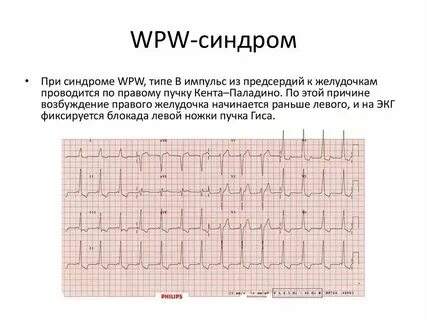 Синдром wpw тип а