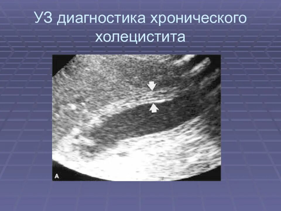 Диагноз калькулезный холецистит. Хронический бескаменный холецистит УЗИ. Холестероз желчного пузыря. Хронический калькулезный холецистит УЗИ. УЗИ желчного пузыря хронический холецистит.