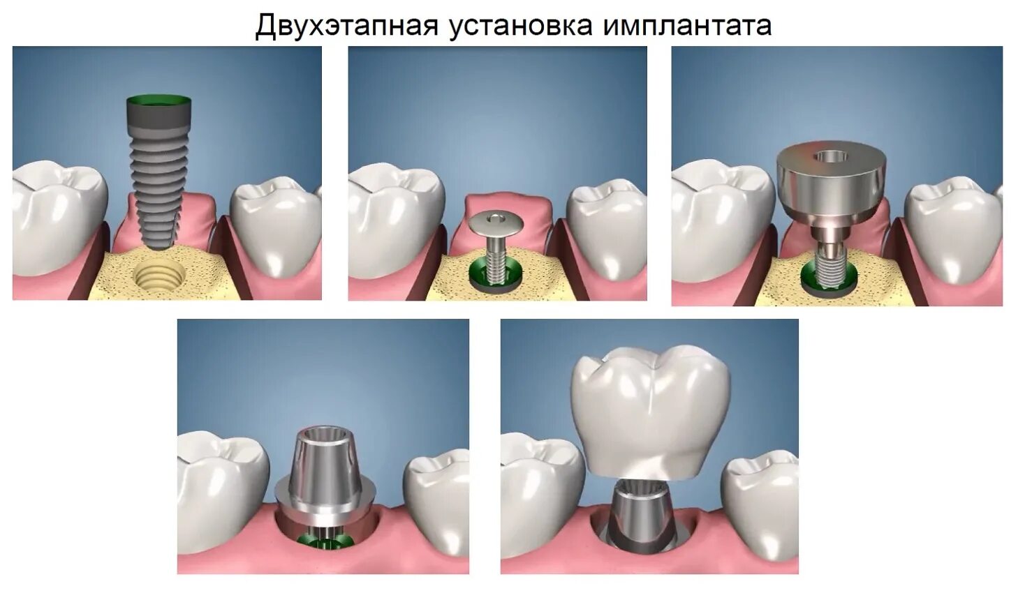 Зубы импланты поэтапно. Двухэтапная имплантация зубов этапы. Двухэтапная методика имплантации. Двухэтапная методика имплантации зубов. Имплантация одноэтапный двухэтапный.