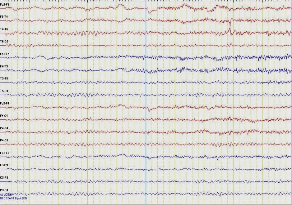 Плохое ээг. ЭЭГ суточный мониторинг. PZ-a2 ЭЭГ. ЭЭГ при БКЯ. Смерть мозга на ЭЭГ.