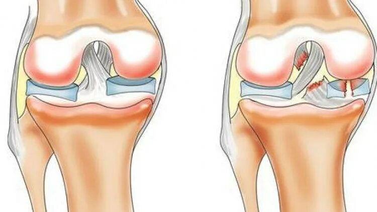 Трещина связке. Травма мениска коленного сустава. Разрыв мениска коленного сустава степени. Операция на крестообразной связки коленного сустава.