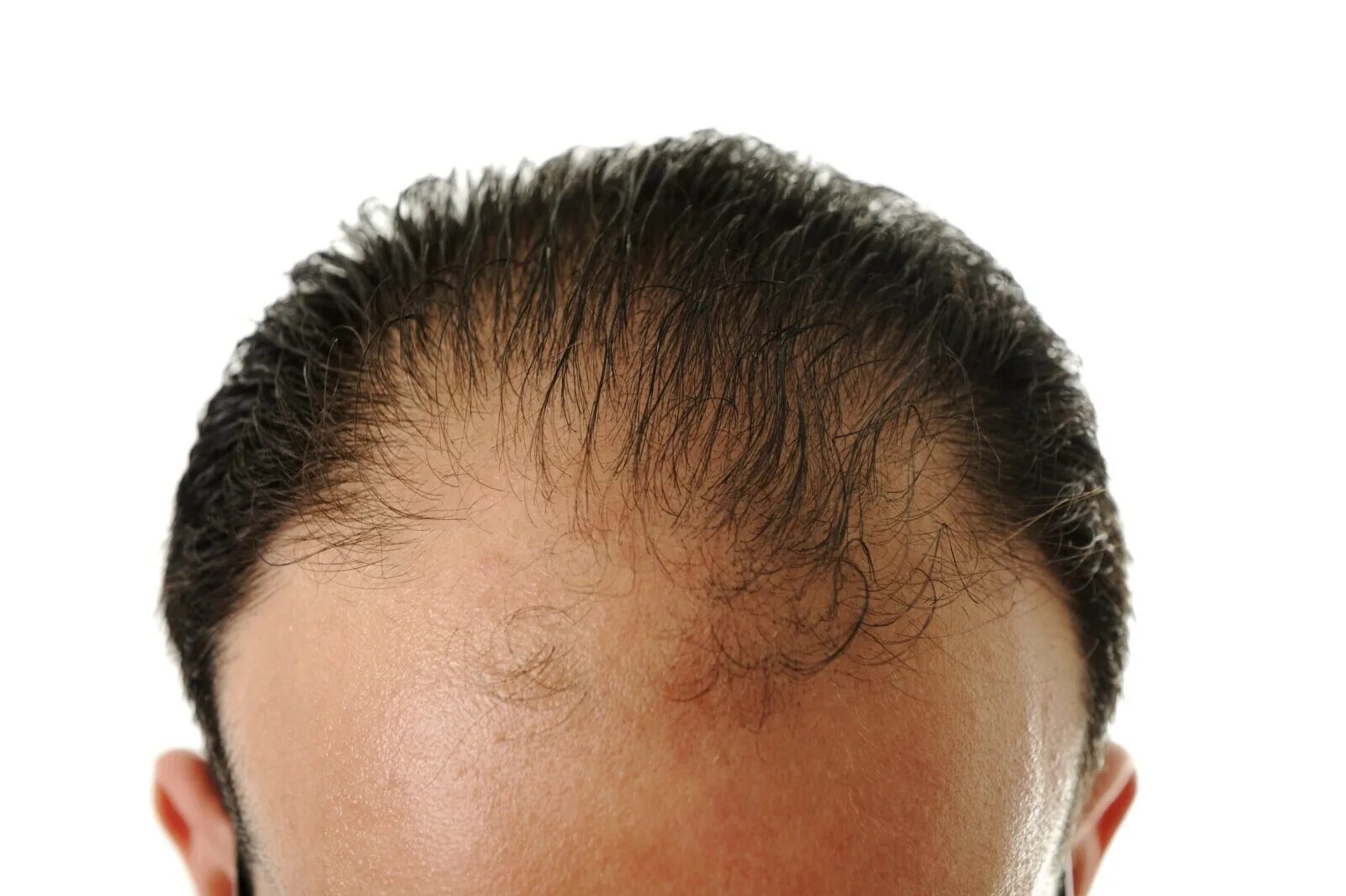 Андрогенетическая и андрогенная алопеция. Очаговая алопеция (alopecia Areata). Андрогенная алопеция алопеция. Симптомы алопеции