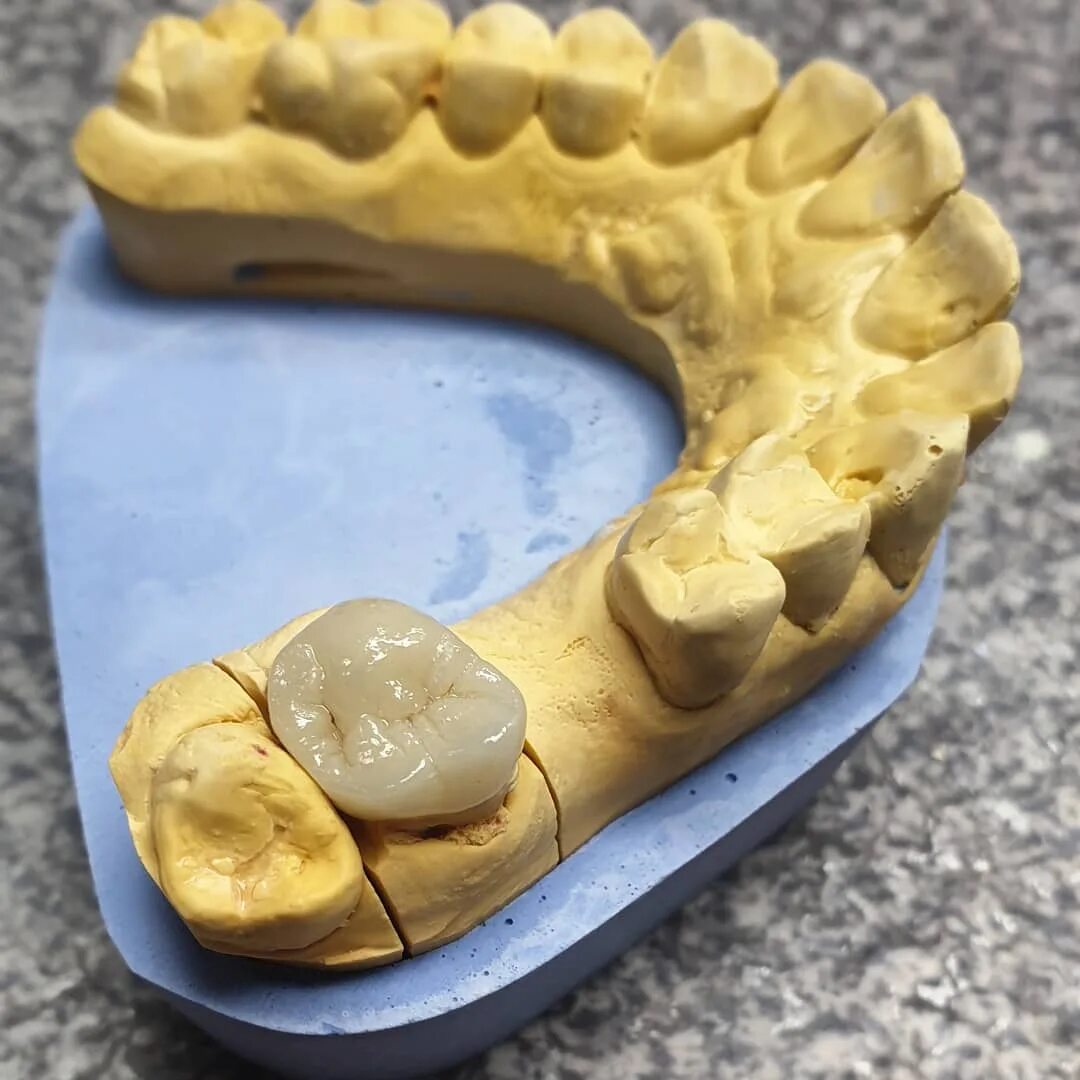 Металлокерамические пластины. Зубные техники владикавказа. Самые дорогие работы для зубного техника. Профессия зубной техник. Ростов зубной техник.
