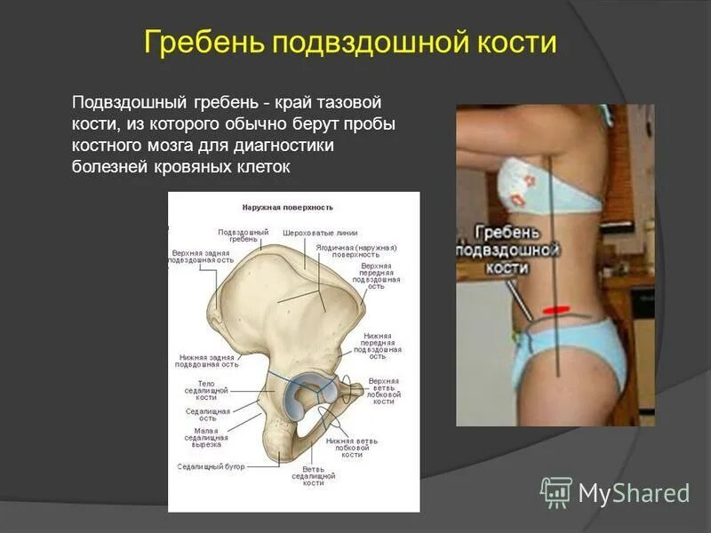 Подвздошной кости 2. Подвздошная кость. Подвздошный гребень тазовой кости. Анатомическое образование подвздошной кости. Гребеоь позвдошнл кости.