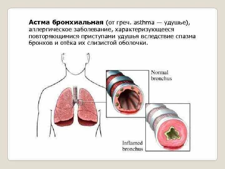 Бронхиальная астма отек легких. Бронхиальная астма удушье. Бронхиальной астме – слизистой;. Оболочки бронхов.