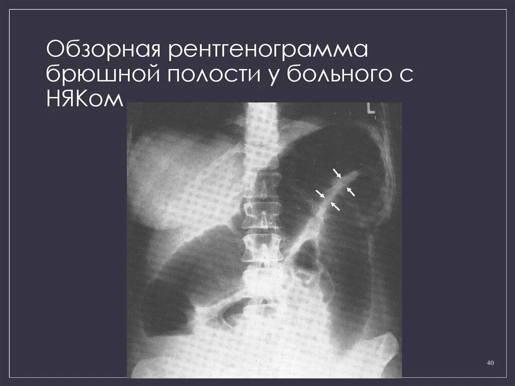 Обзорная рентгенография. Няк обзорная рентгенограмма. Обзорная рентгенограмма брюшной полости. Обзорная рентгенографиябрюшной полочти. Обзорная рентгенография органов брюшной полости.