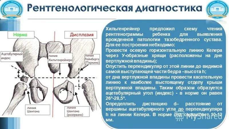 Патология тазобедренного сустава. Аномалии тазобедренного сустава у детей. Схема Хильгенрейнера тазобедренных суставов у детей. Y образные хрчщт. Ортопедическая патология.