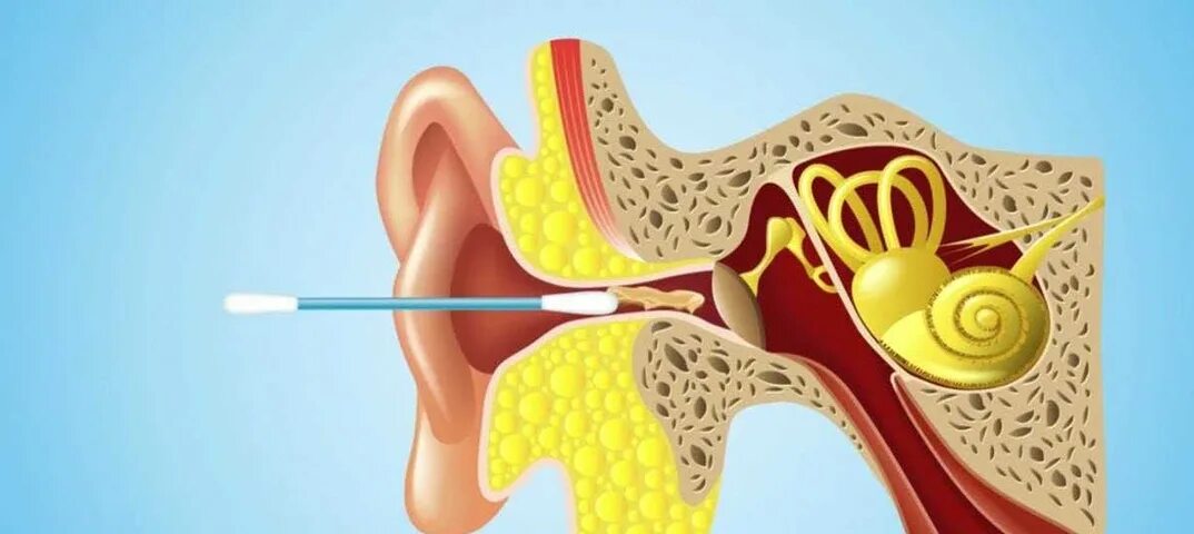 Как прочистить серную пробку. Серная пробка на барабанной перепонке. Анатомия уха серная пробка. Строение уха человека серная пробка. Строение уха ушная пробка.