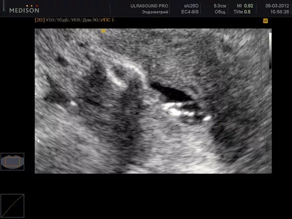 синехии в полости матки на узи. синехии в полости матки на узи. внутриматочные синехии на узи что это такое. синехии в полости матки на узи. синехии в полости матки на узи.