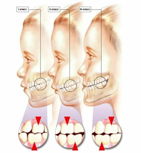 Зубы при закрытом рте. Мезиальный прикус степени. Мезиальная ступень в Молочном прикусе. Мезиальный прикус Энгля.