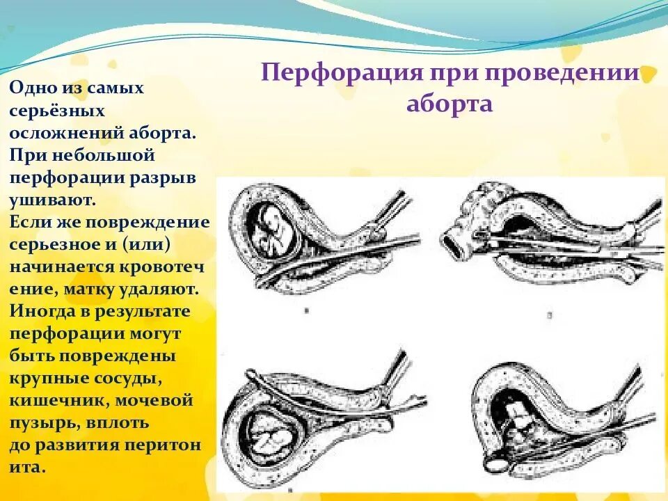 Операция 4 неделя. Перфорация матки осложнения. После хирургического аборта. Хирургический аборт сроки. Осложнения самопроизвольного аборта.