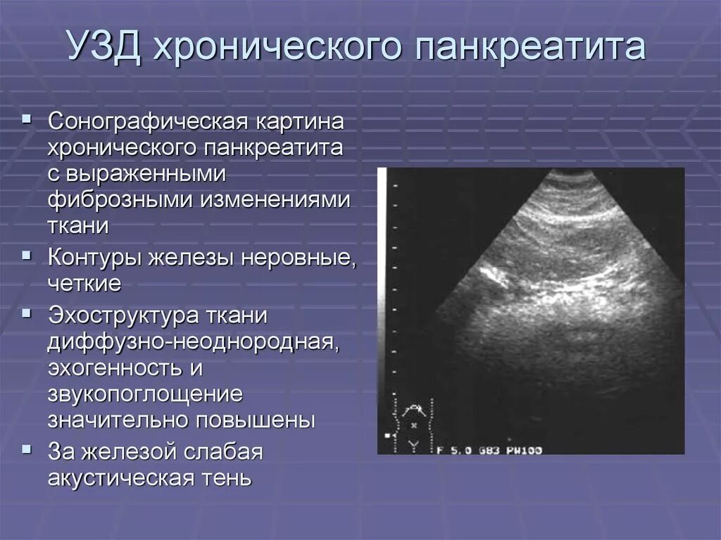 Хронические диффузные изменения печени. УЗИ картина хронического панкреатита. Хронический панкреатит УЗИ. Острый панкреатит при УЗИ. Хронический панкреатит диагностика УЗИ.