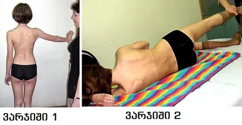Как избавиться от сколиоза