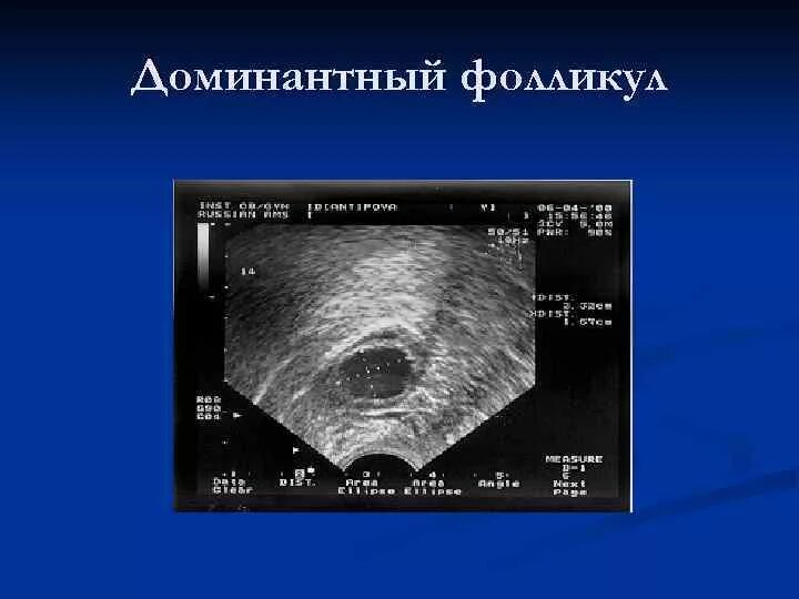 Фолликул яичника размеры. УЗИ яичников доминантный фолликул. Доминантный фолликул на УЗИ. Доминантный фолликул УЗИ 20 мм.