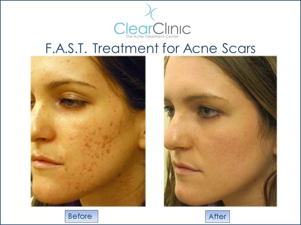 Acne program