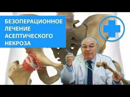 Остеонекроз лечение